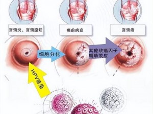 夫妻行房女性出血可能是千金露的原因