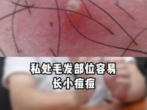 女生隐私地方起了个痘怎么治—女生隐私部位起痘如何处理