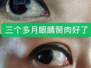 胬肉治疗免费观看，专家解析治疗方法及产品效果