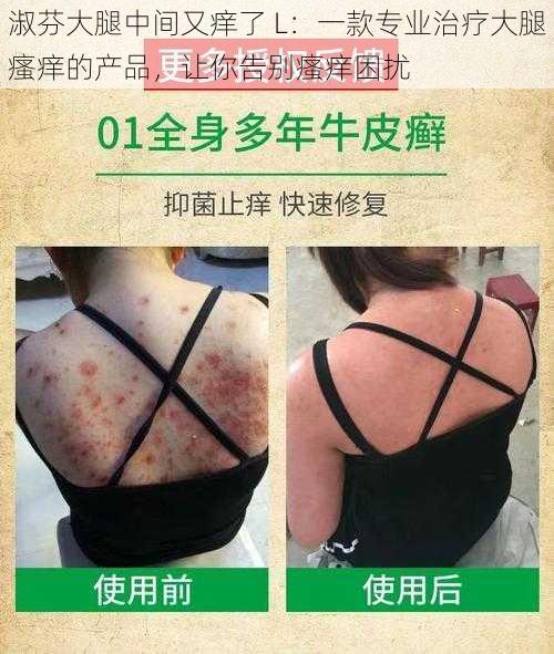 淑芬大腿中间又痒了 L：一款专业治疗大腿瘙痒的产品，让你告别瘙痒困扰