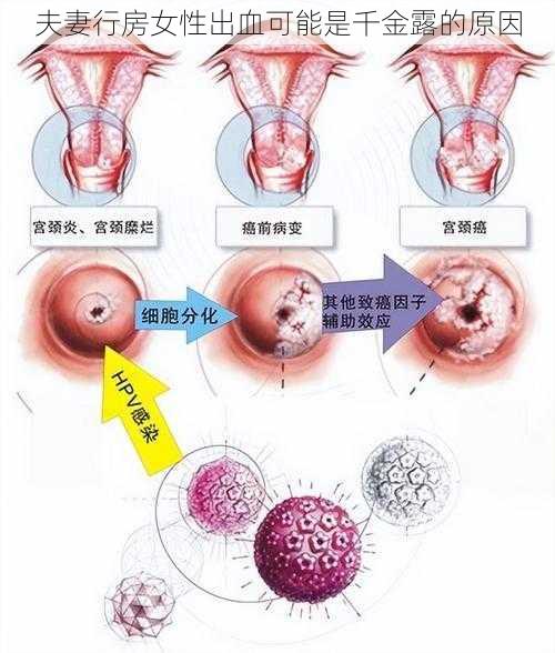 夫妻行房女性出血可能是千金露的原因