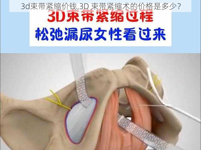 3d束带紧缩价钱,3D 束带紧缩术的价格是多少？